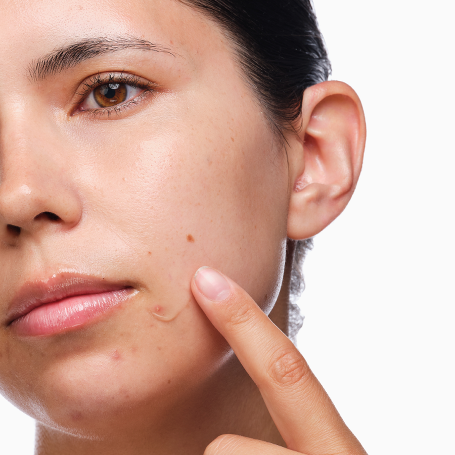 the-acne-set-a7 rdn-the-acne-set-application.png