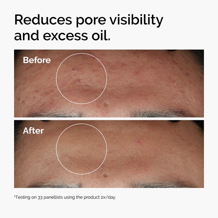 niacinamide-10-zinc-1-g3 ord-niacinamide-zinc-blemish-serum-before-after-pores.jpg