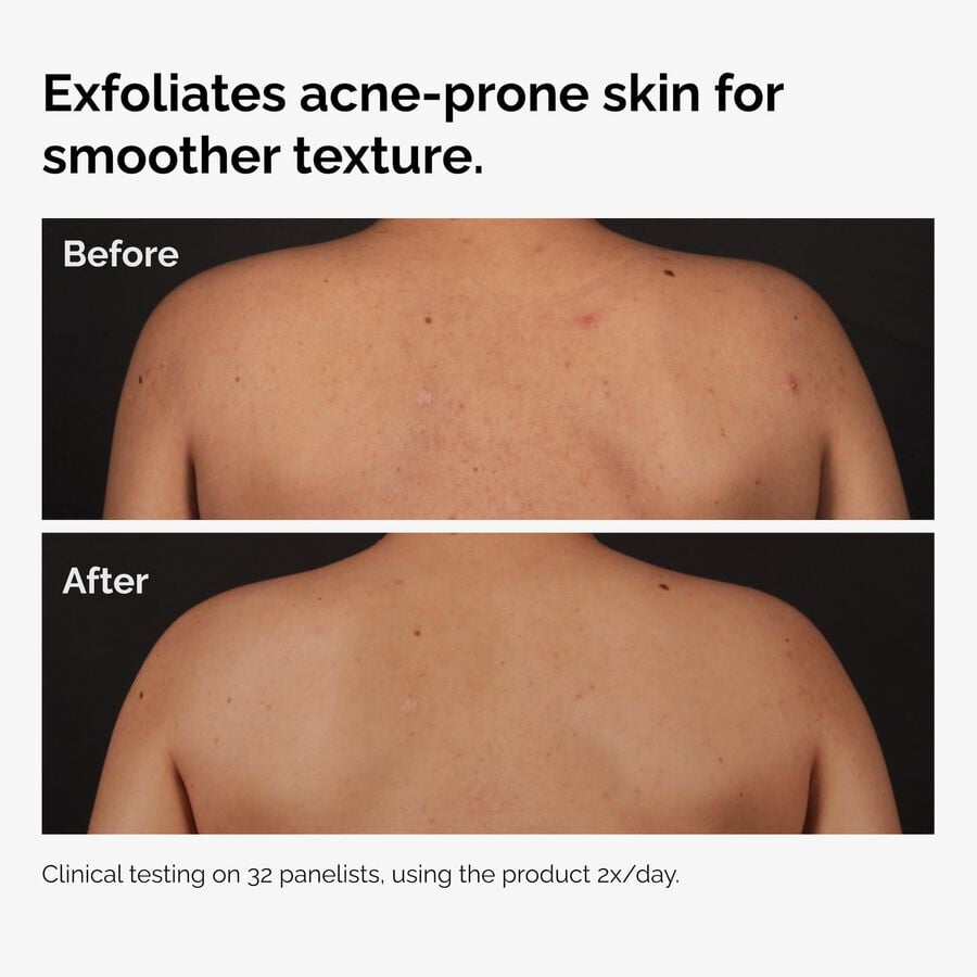 salicylic-acid-0-5-body-serum-u3 ord-salicylic-acid-body-serum-before-after-graphic-NA.jpg